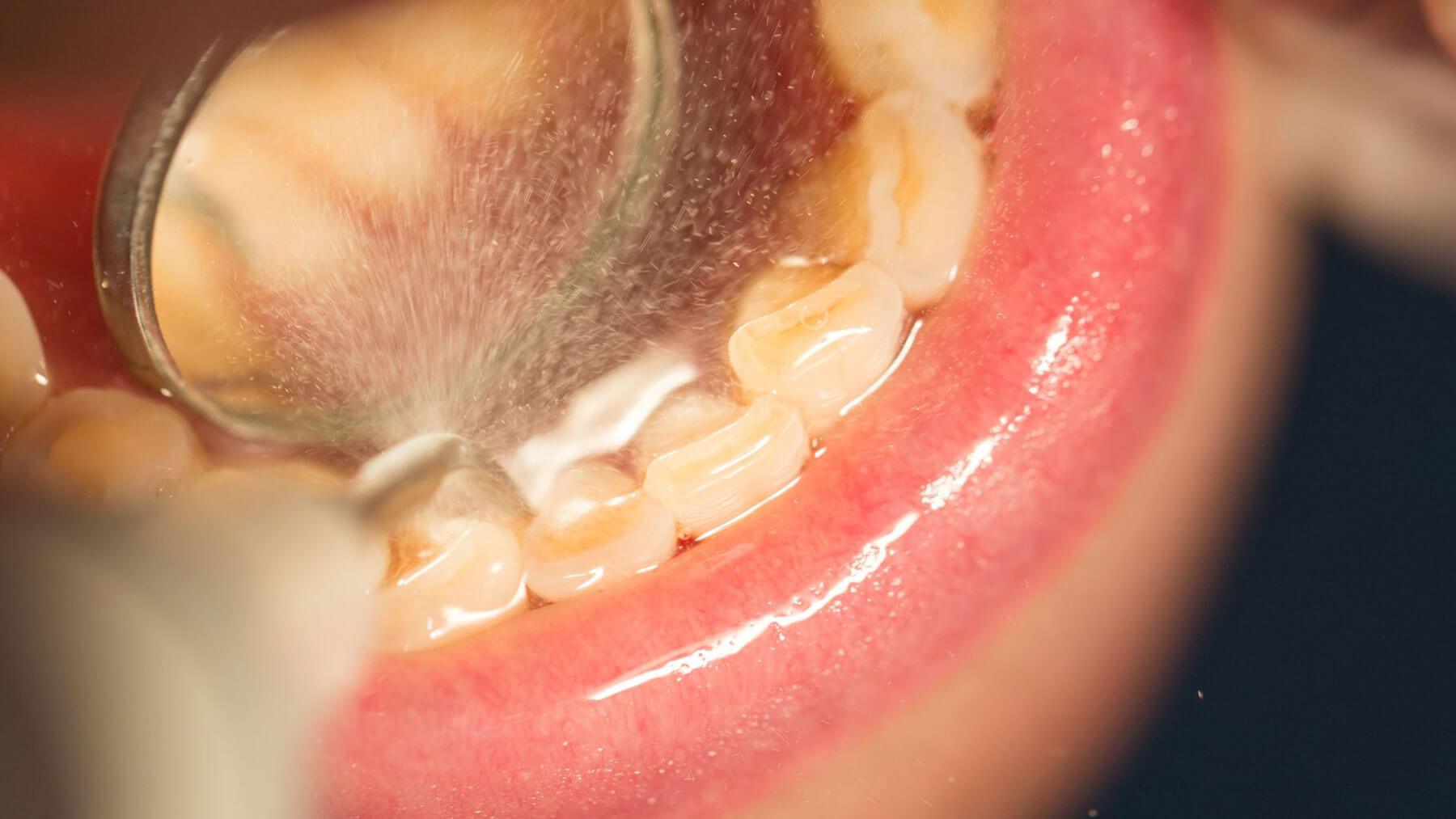 Dental hygienist removing tartar teeth during a routine scaling appointment (non-graphic)