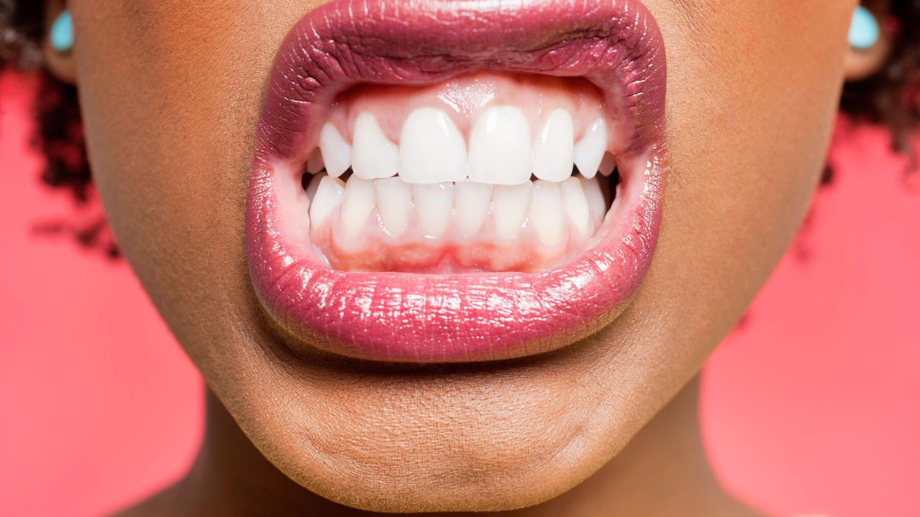 Bruxism