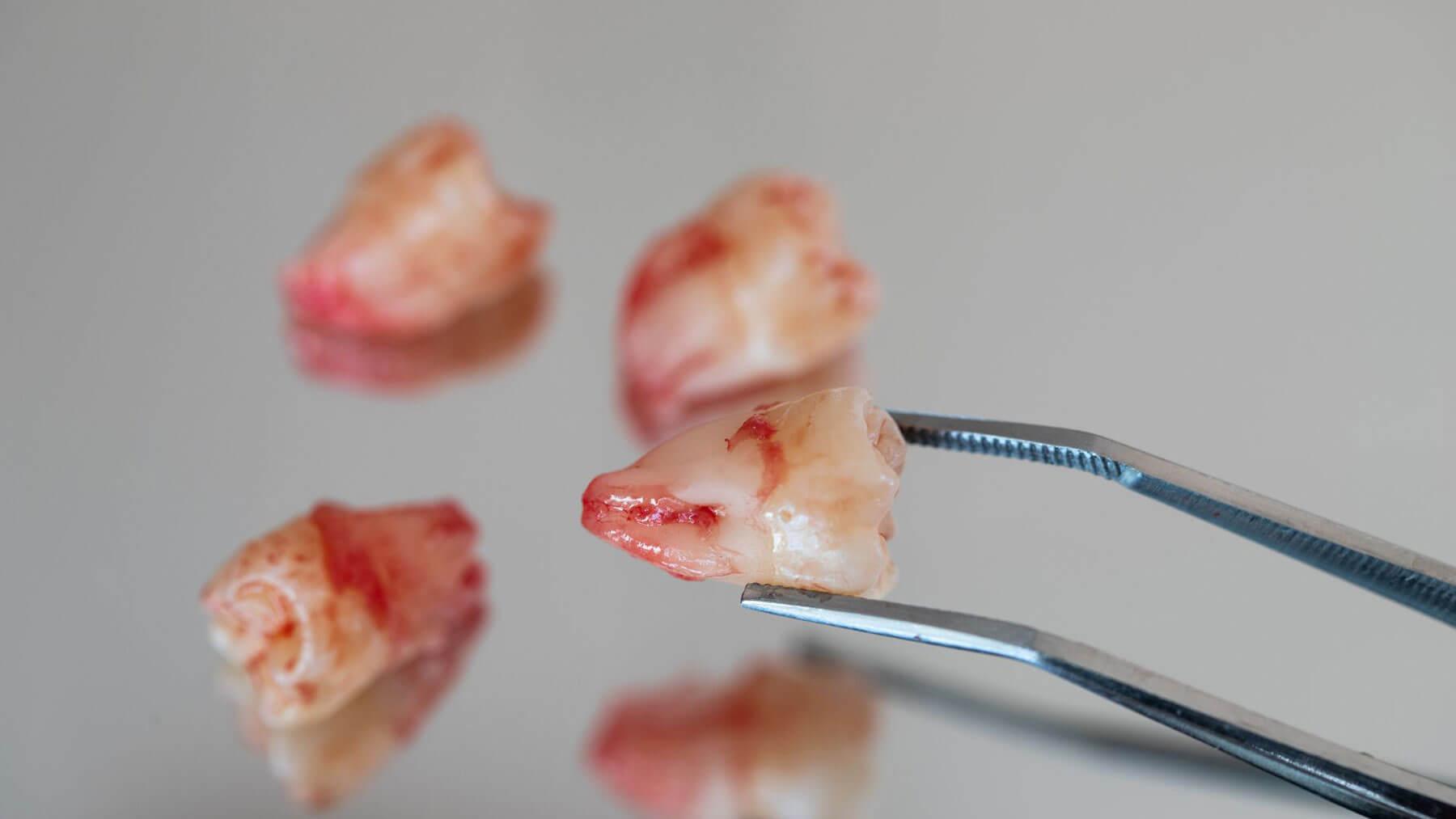 Dental Extraction For Wisdom Teeth in Carlsbad
