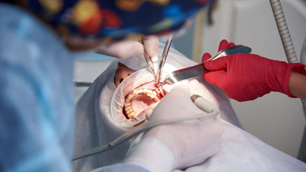 Complex Extraction Wisdom Teeth