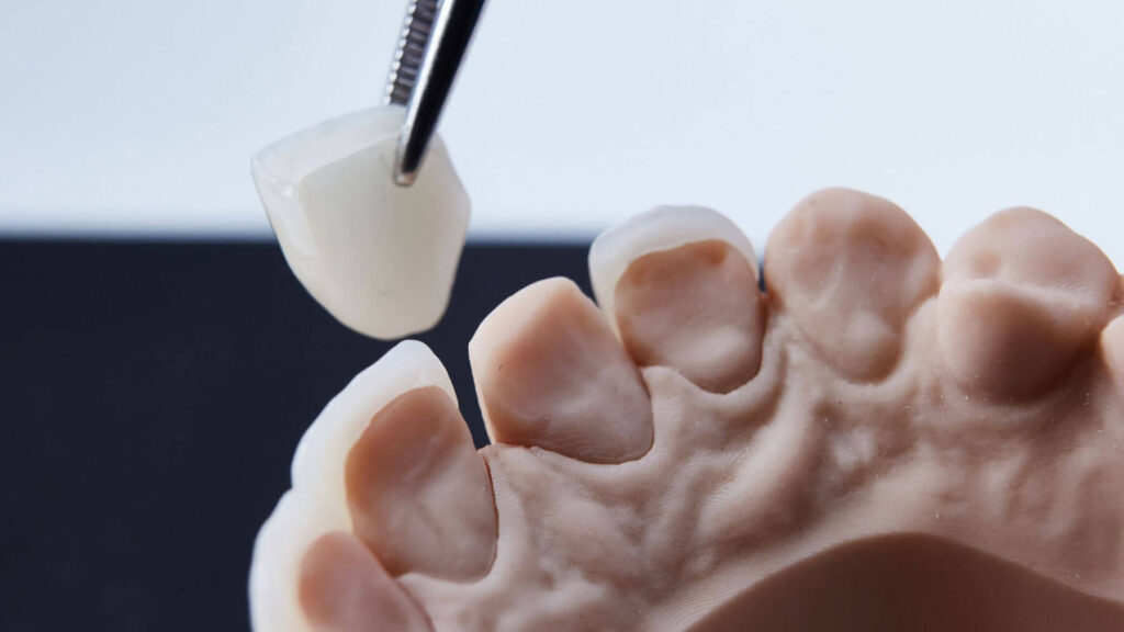 How Long Do Dental Crowns Last?