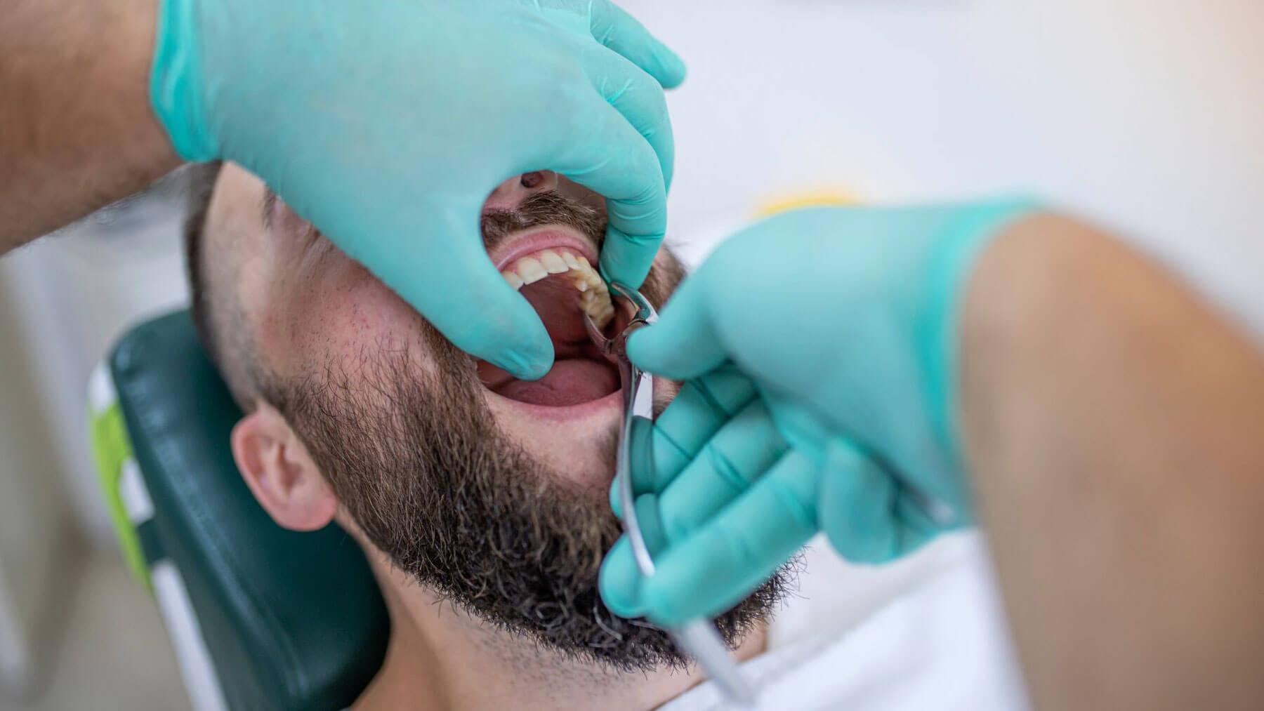 Dental extraction in Carlsbad at Smiles For Health