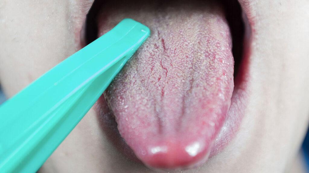Dry Mouth For Ozempic Teeth