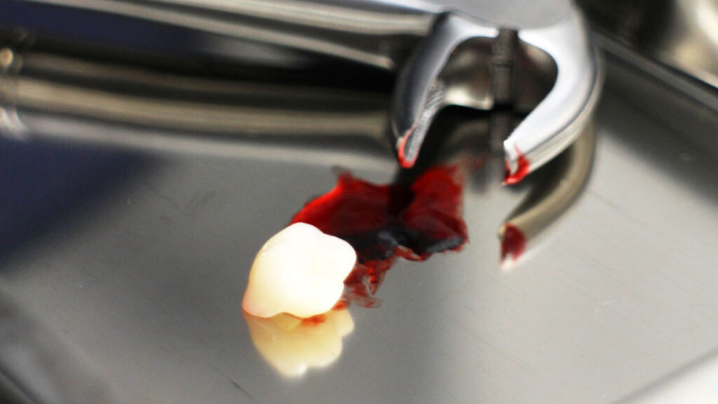 Dental instruments set up for a extraction procedure