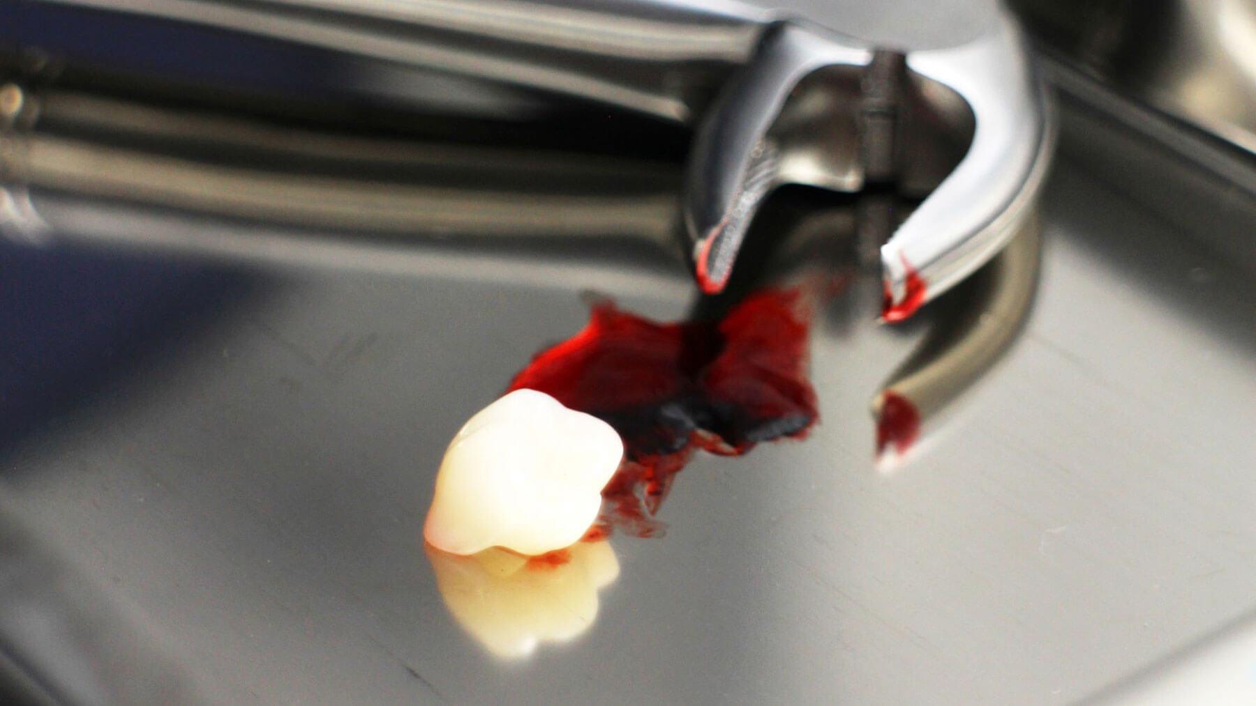 Dental extraction in Carlsbad at Smiles For Health