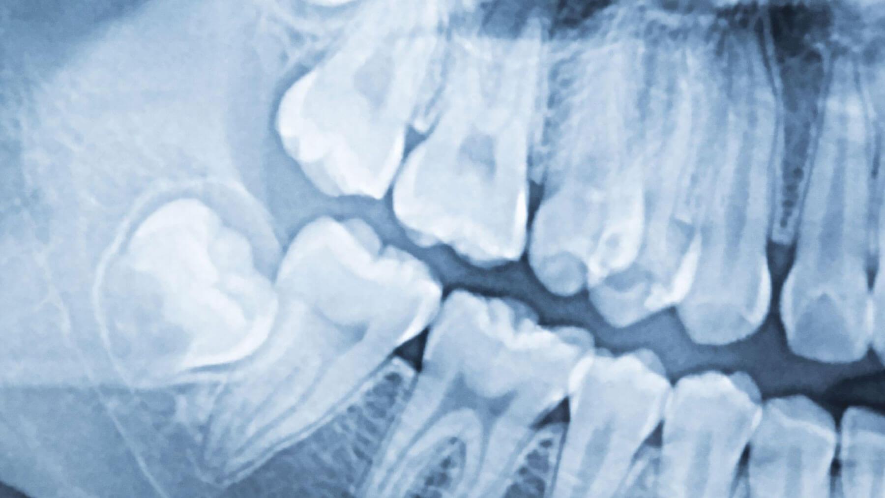 3D scan or X-ray showing impacted wisdom teeth before surgical extraction