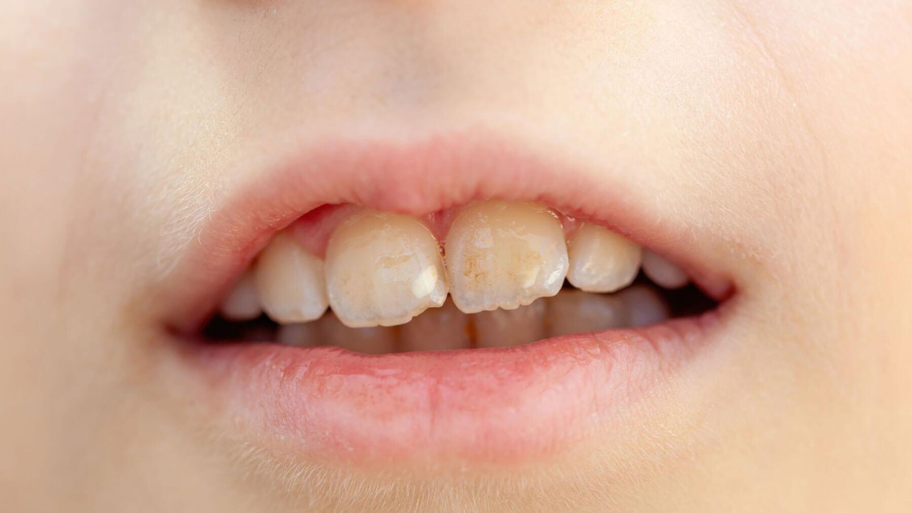 Fast Sensitive Teeth Relief That Works