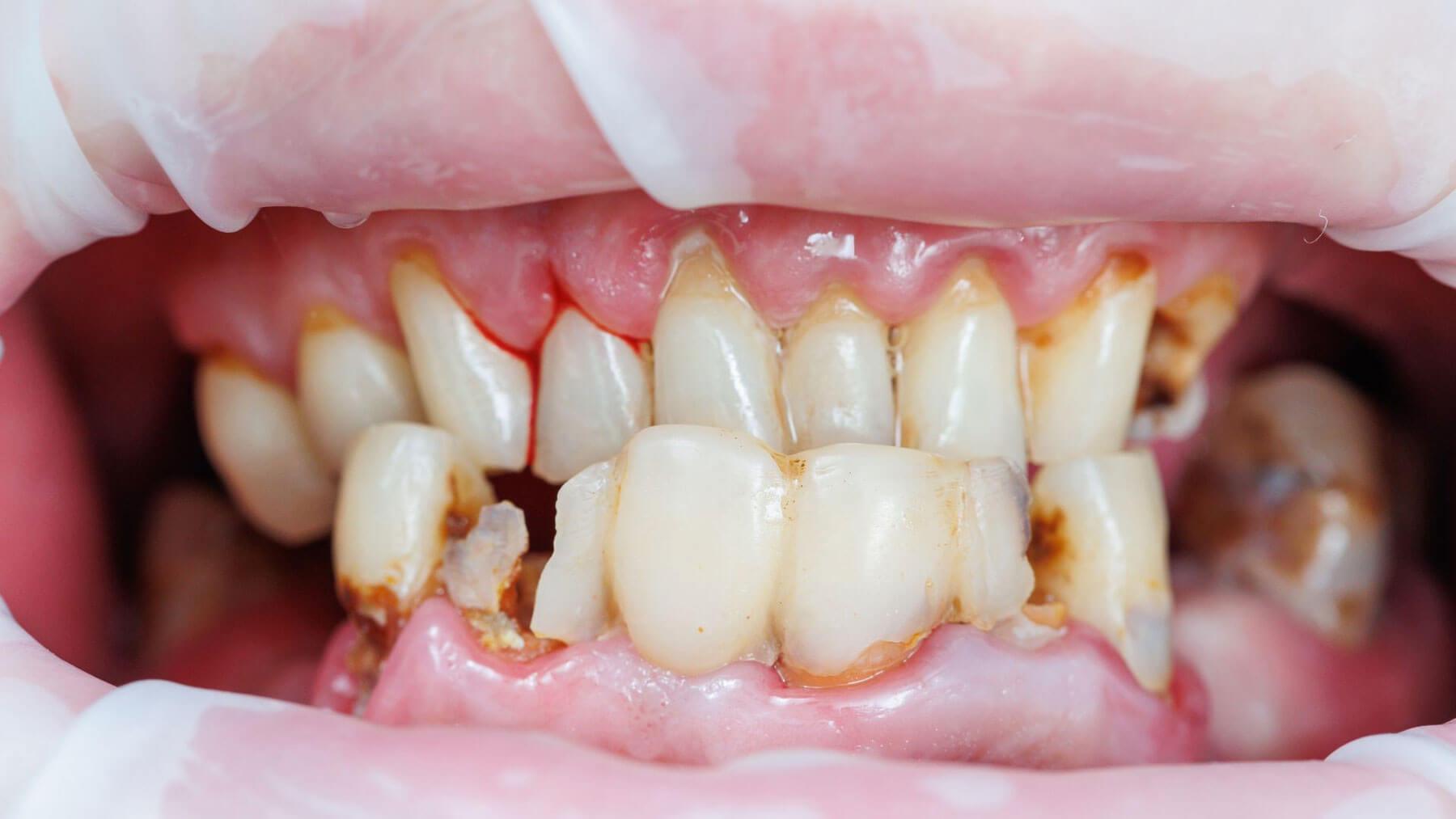 enamel erosion from acidic foods contributing to tooth sensitivity pain