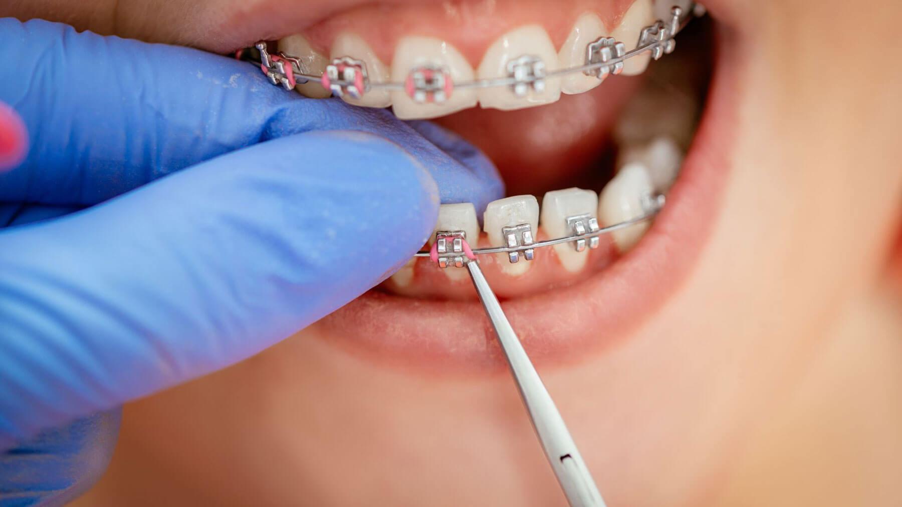 If I Have Braces Should Avoid Chewing Ice