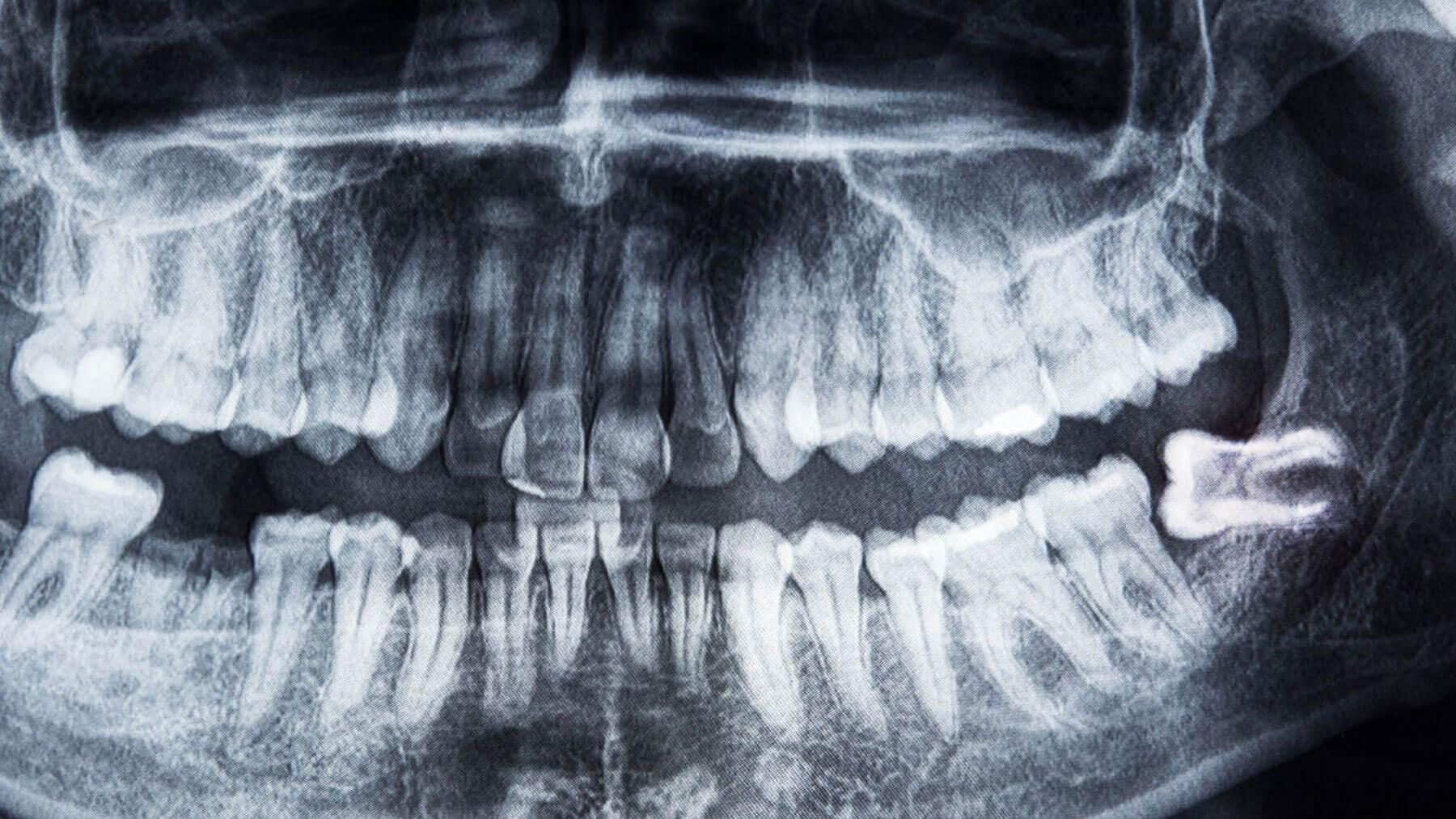 Side view of lower jaw showing impacted wisdom teeth location pre-extraction