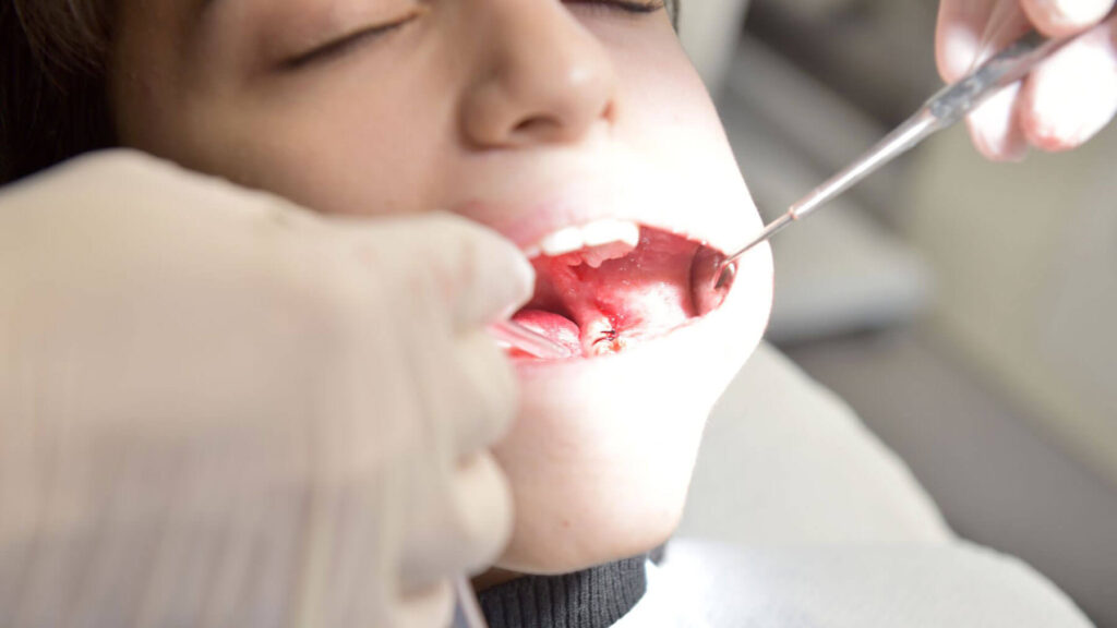 Recovery of Surgery Wisdom Teeth