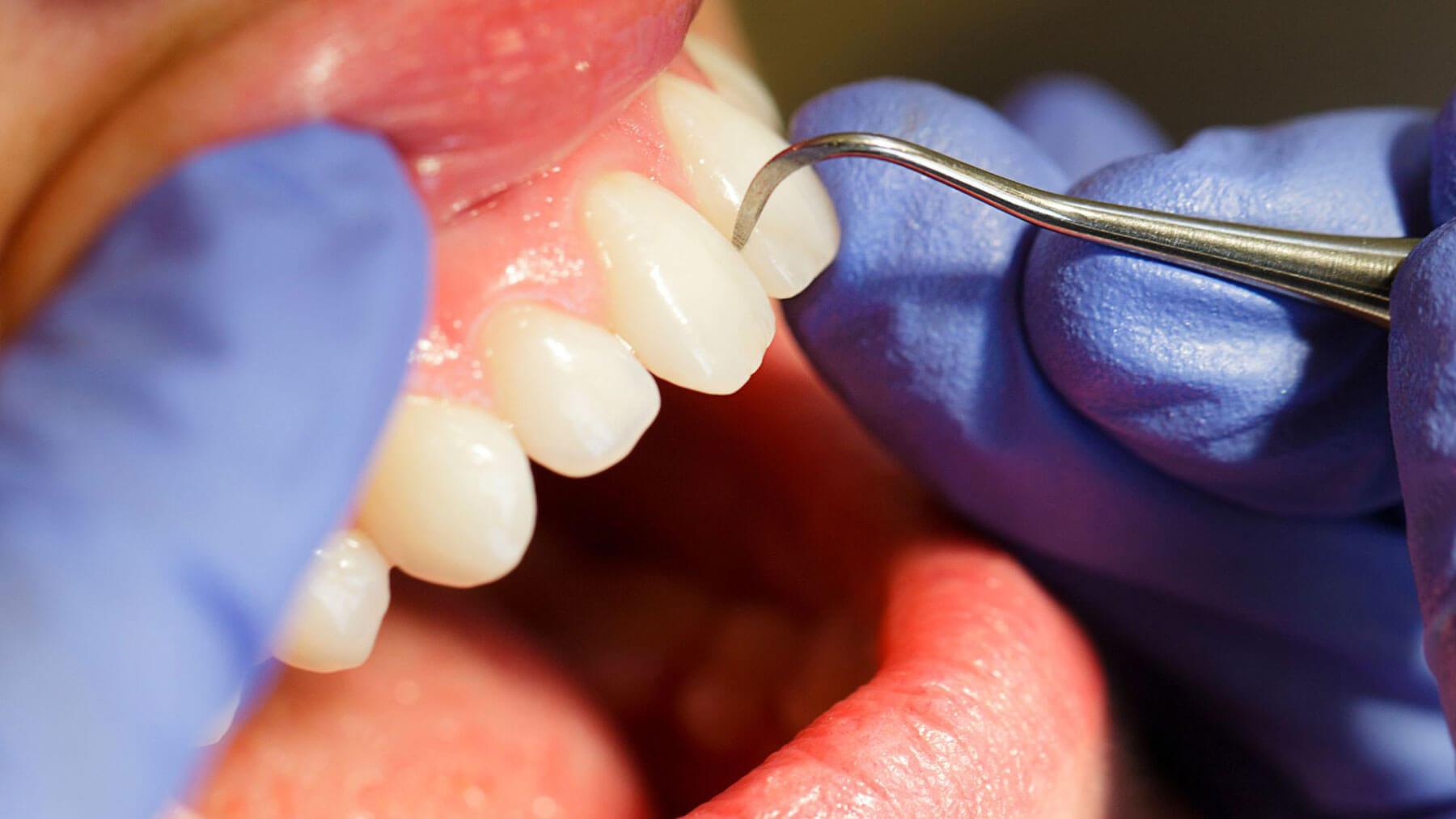 Regular Exams After Dental Crown