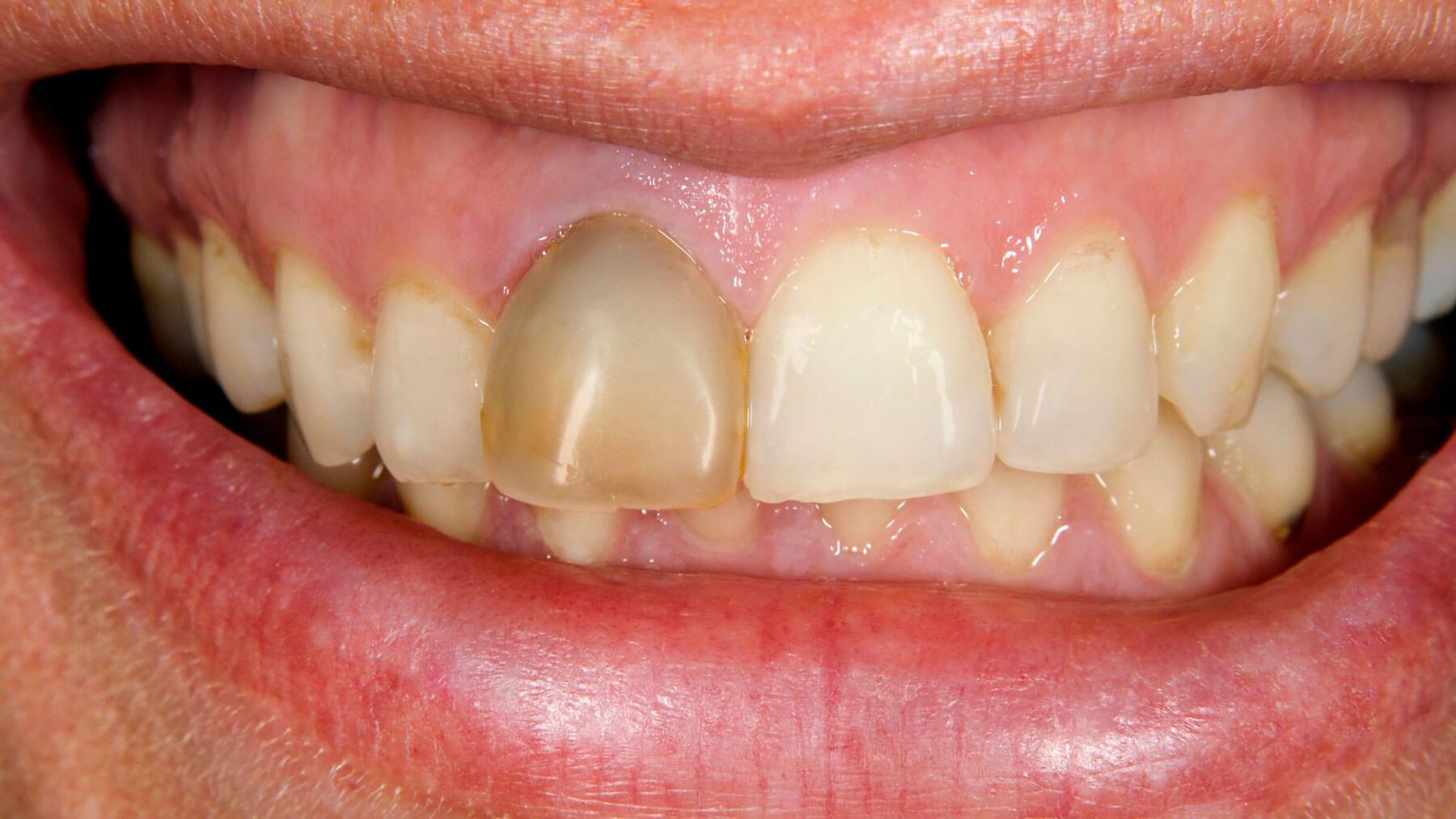 Root-Canal-Exposure