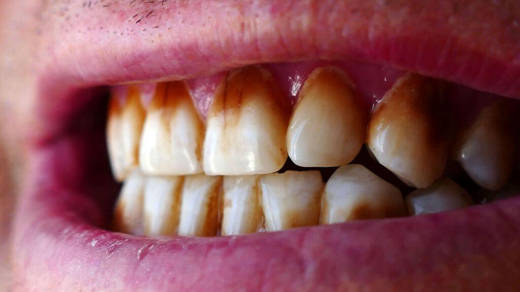 Stain teeth For Genetic and Dark Berverages