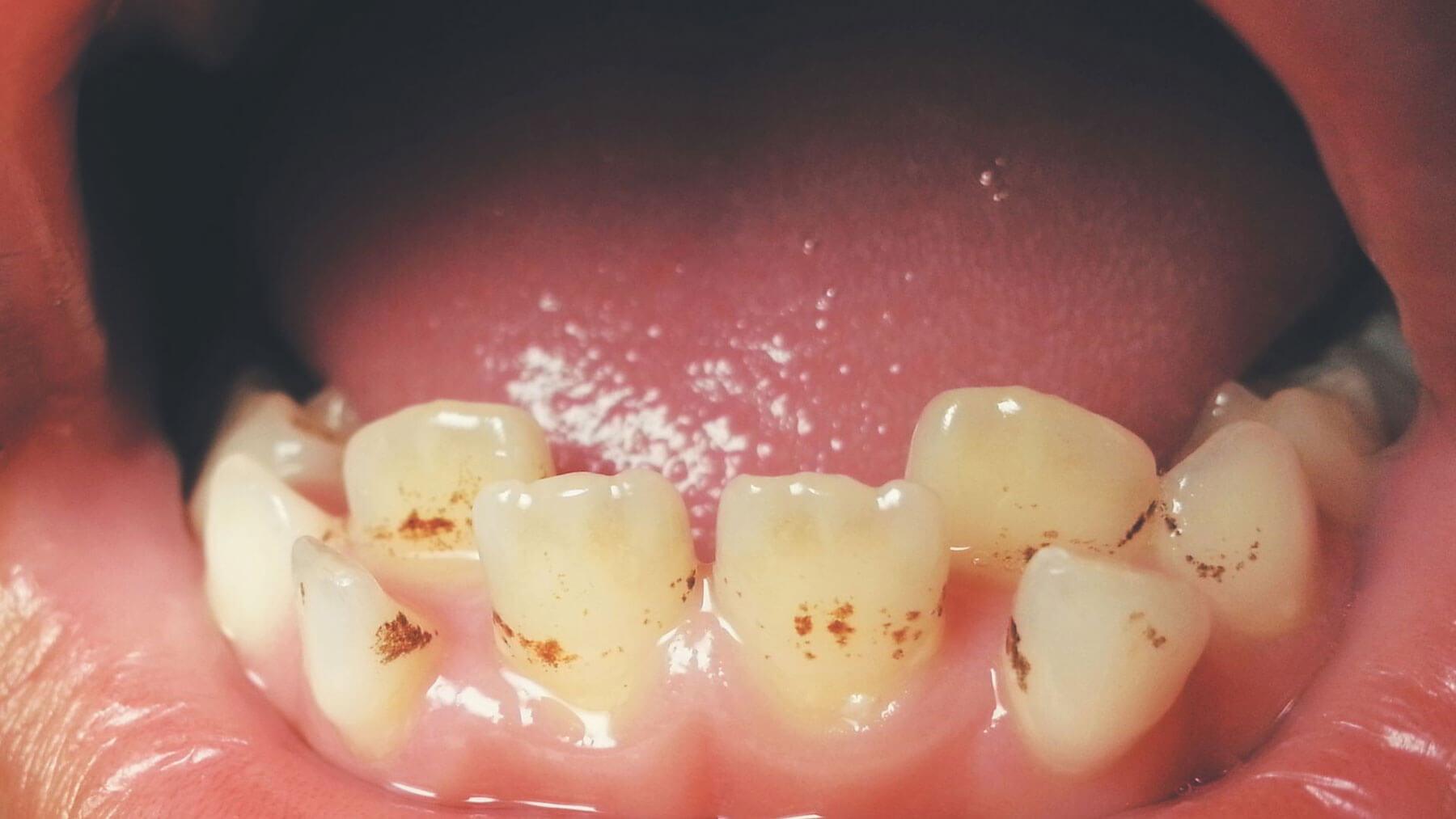 Close-up of tartar buildup along the gumline before professional cleaning