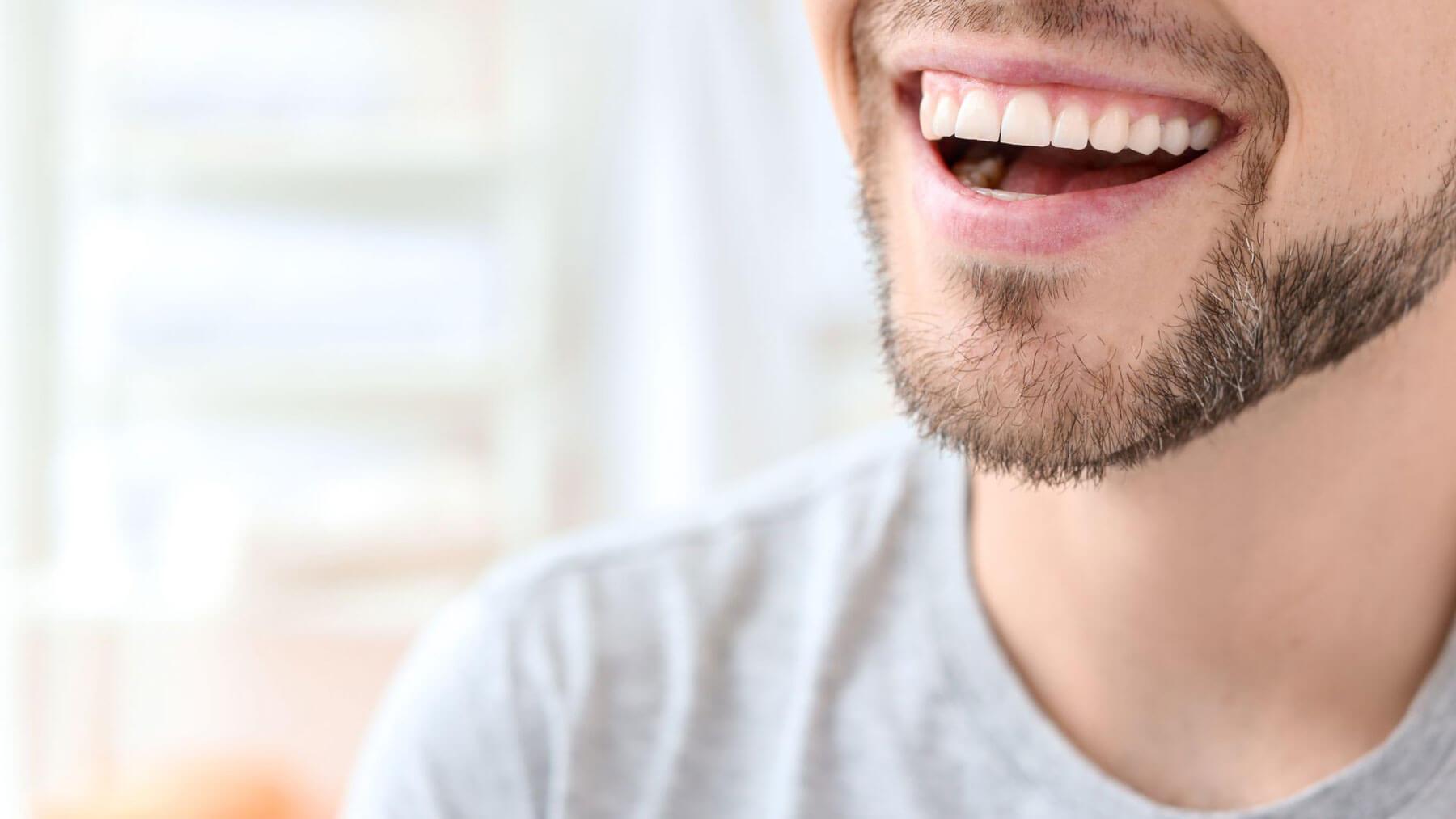 Professional teeth whitening treatment in Carlsbad for noticeable shade change
