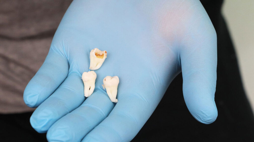 Wisdom Tooth Extraction