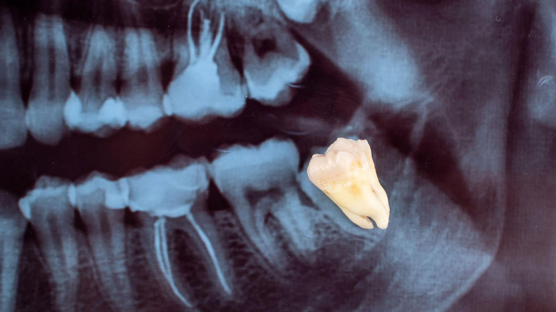 X-Ray For Determinate If Need Surgical Wisdom Teeth Removal
