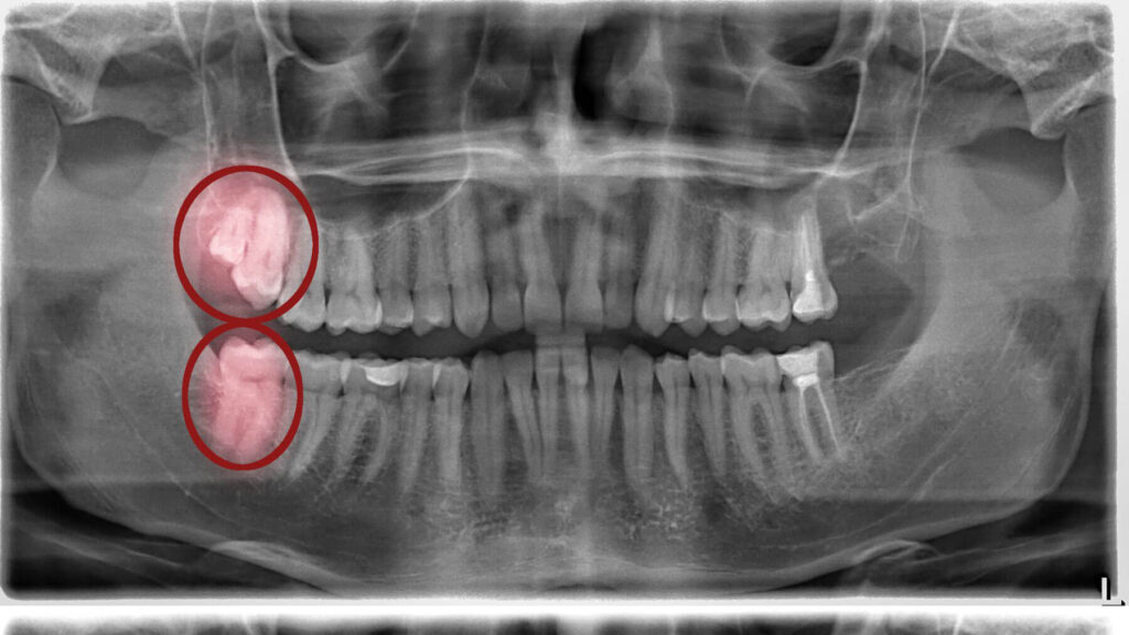 Comestic Dental Extraction Wisdom Teeth