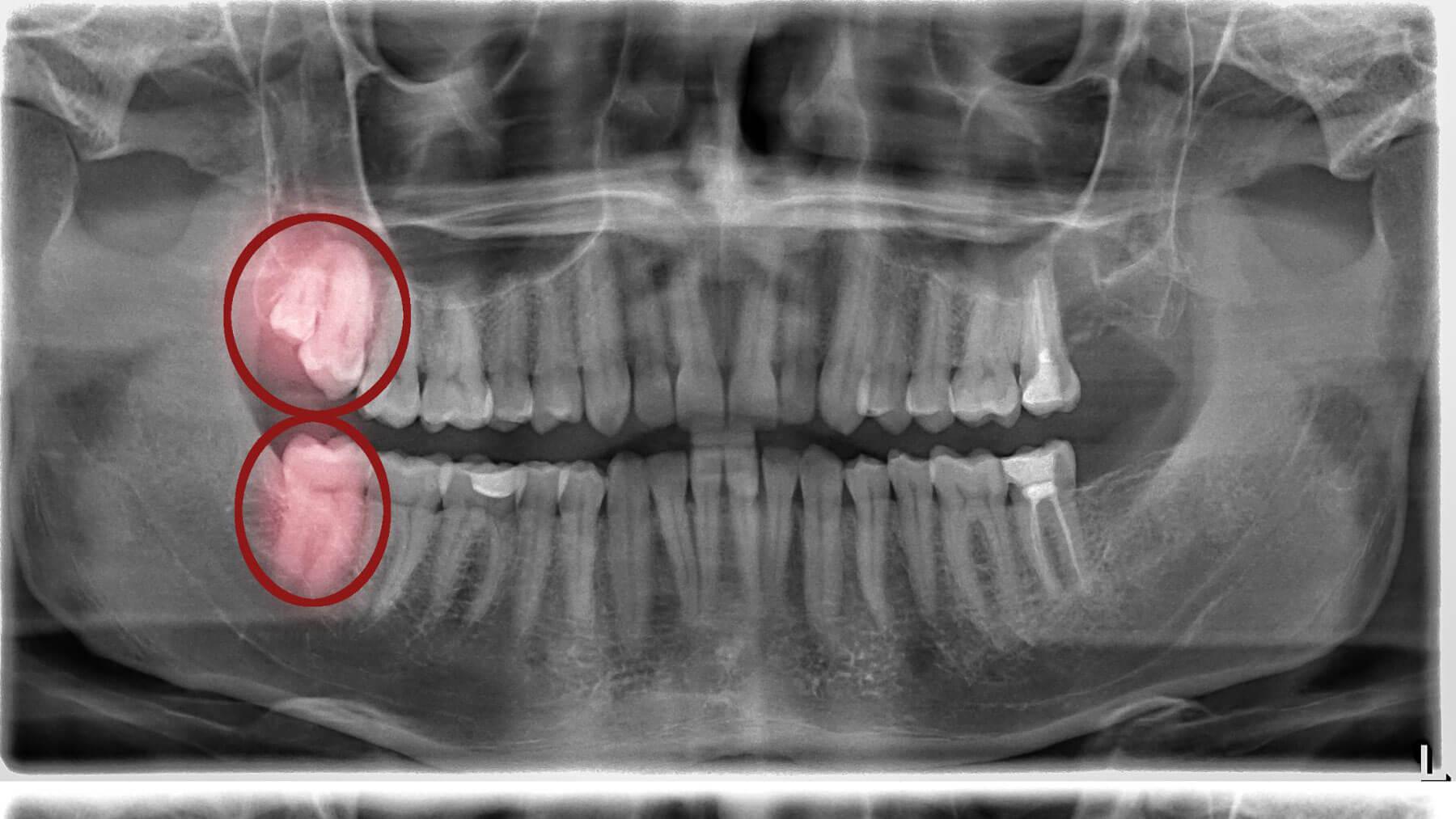 X-Ray at dental Check Up