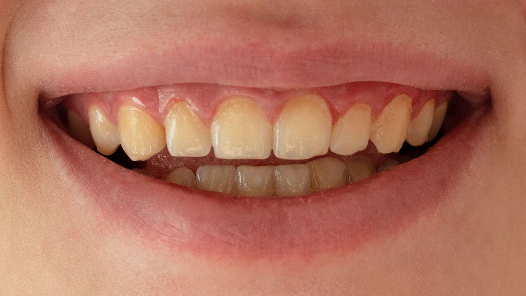 Yellow Teeth For Dark Beverages