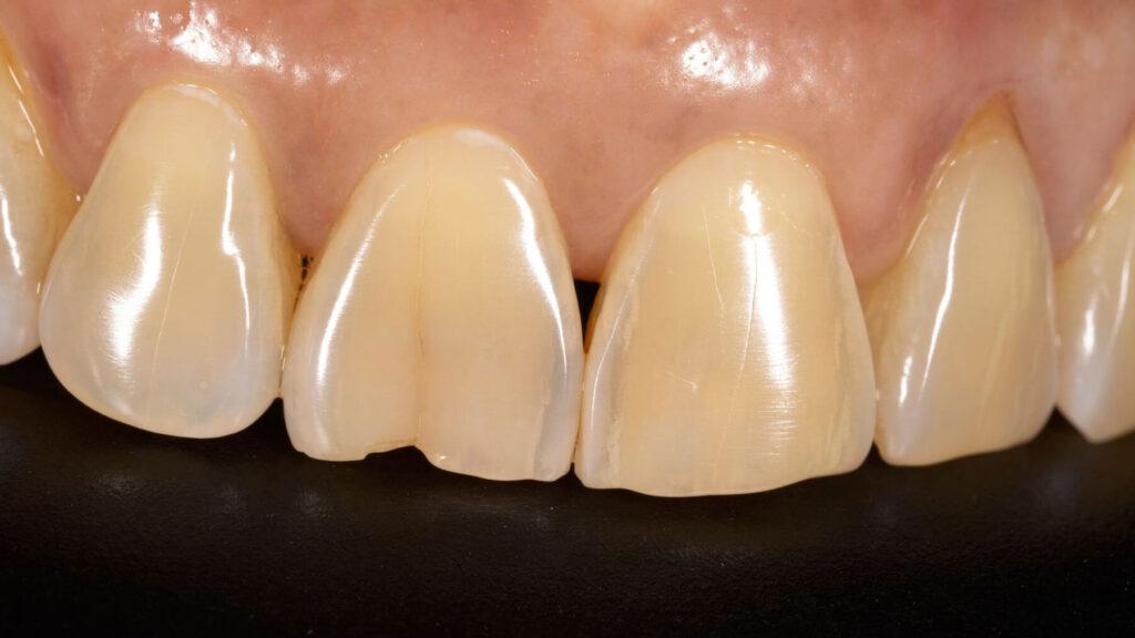 What Causes A Tooth To Crack