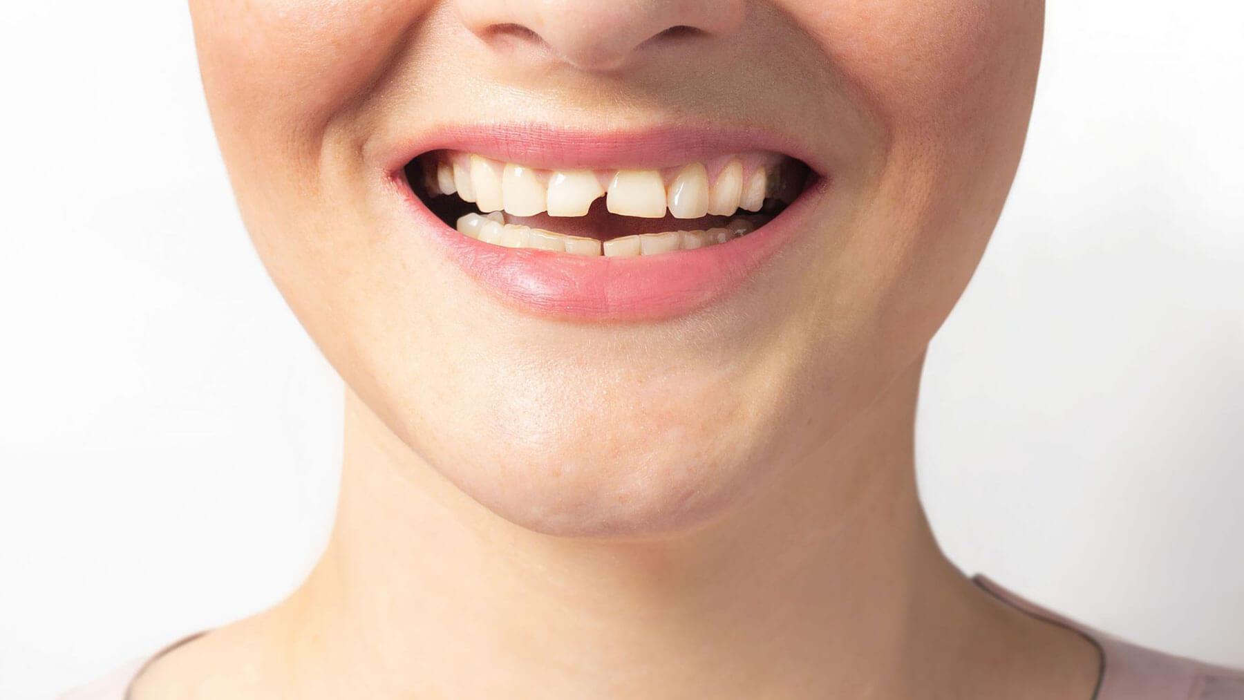 Is a Chipped Tooth an Emergency?