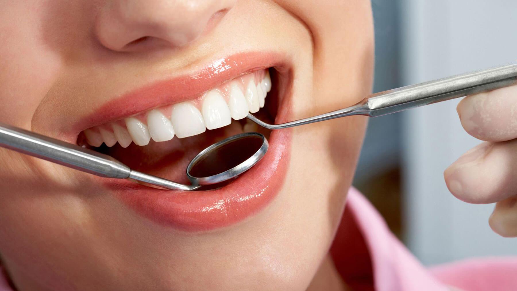 Dental Bonding for Fix Chipped Tooth