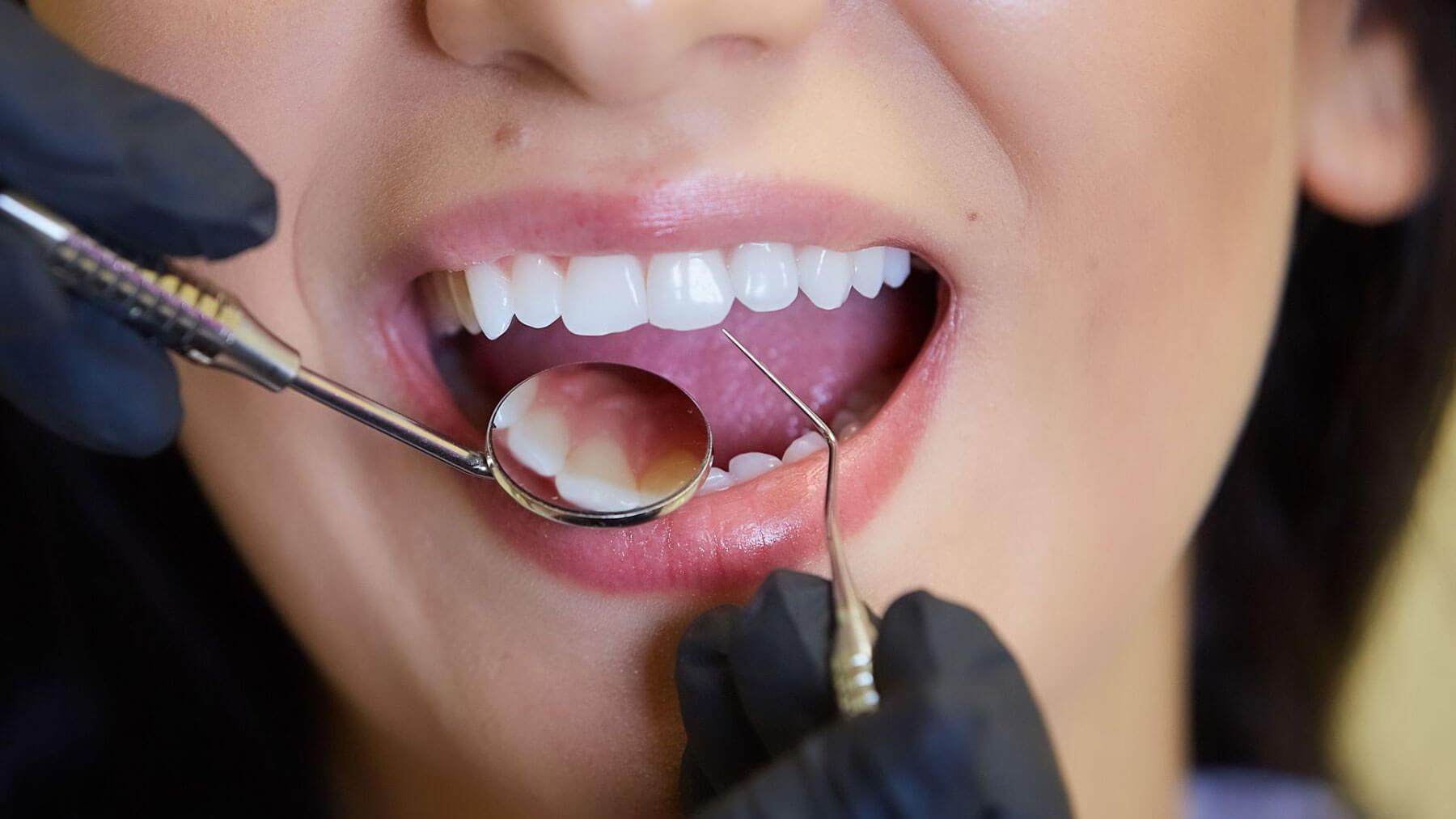 Dental Bonding for Cracked Tooth Treatment
