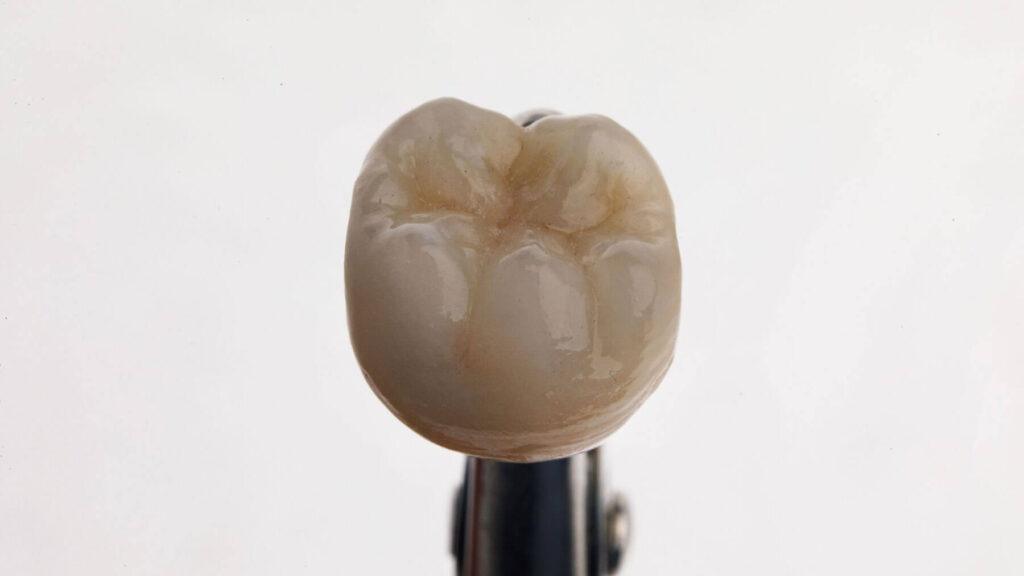 What is a Crown on a Tooth?