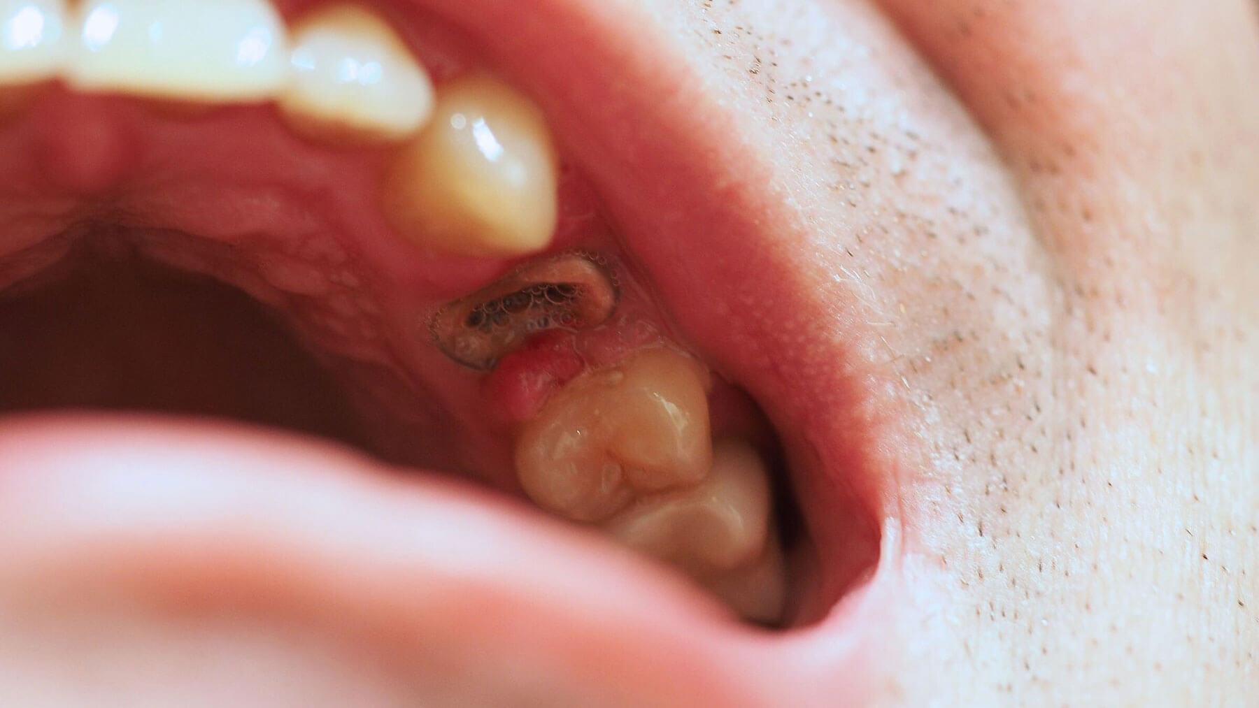Dental Emergency - Smiles For Health