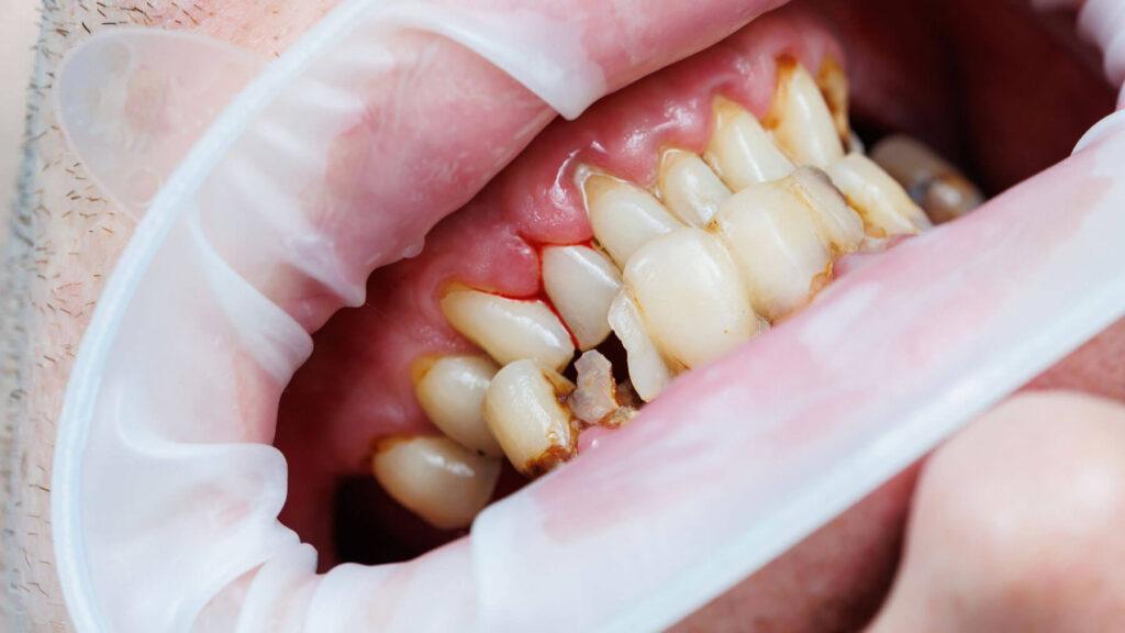 Can A Tooth Infection Kill You