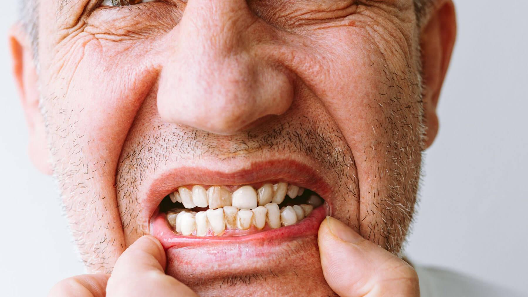 Dental Plaque Can Cause Dental Infection