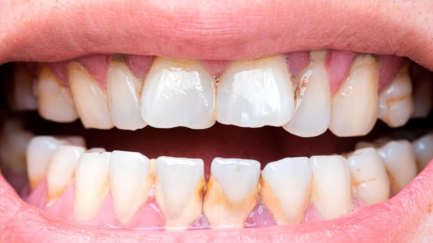 Dental Plaque Cause for Bad Hygiene