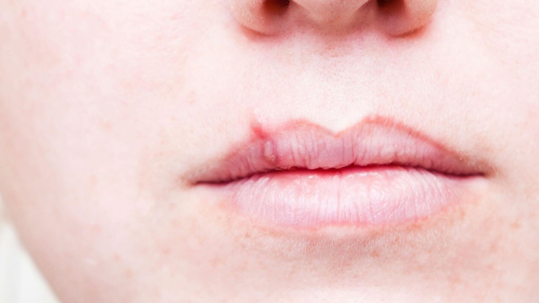 Dry Mouth