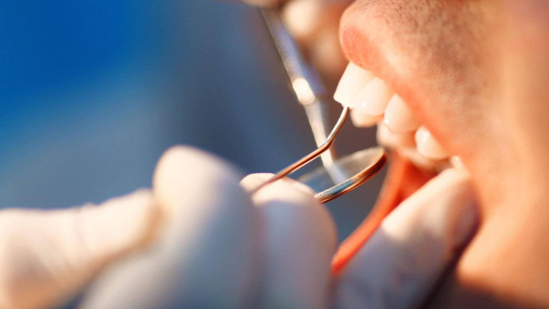 Dental Bonding in Carlsbad - Smiles for Health