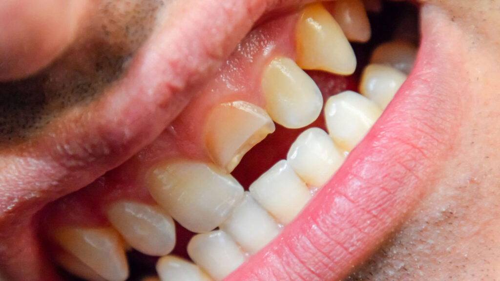 How To Fix a Cracked Tooth Naturally