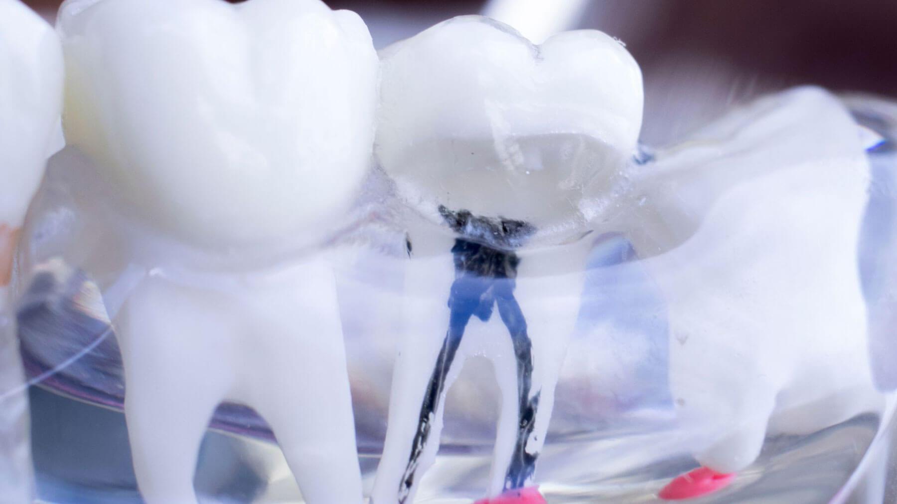 What Happened Inside with a Cracked Tooth