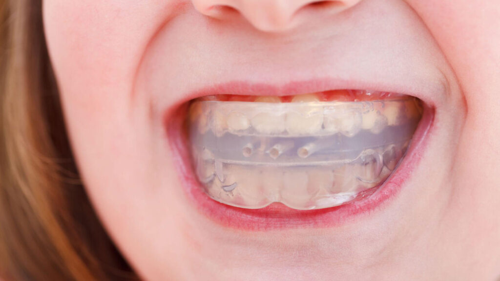 Nightguard for Dental care in Carlsbad
