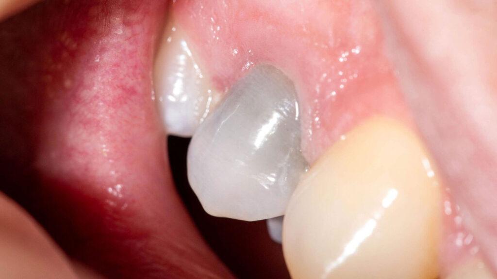 Pain for Bad Dental Filling