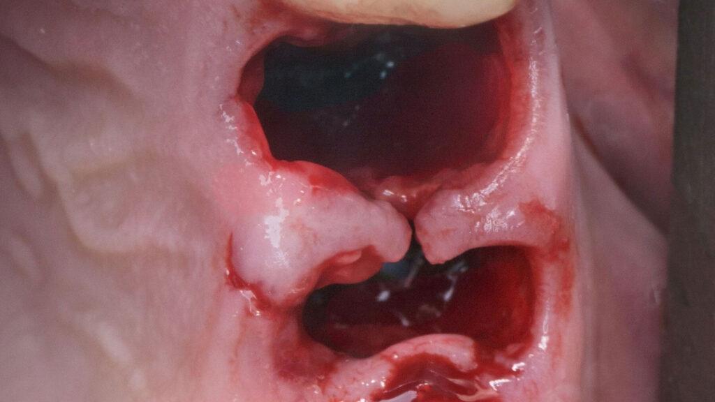 Possible-Dry-Socket-After-Dental-Surgery