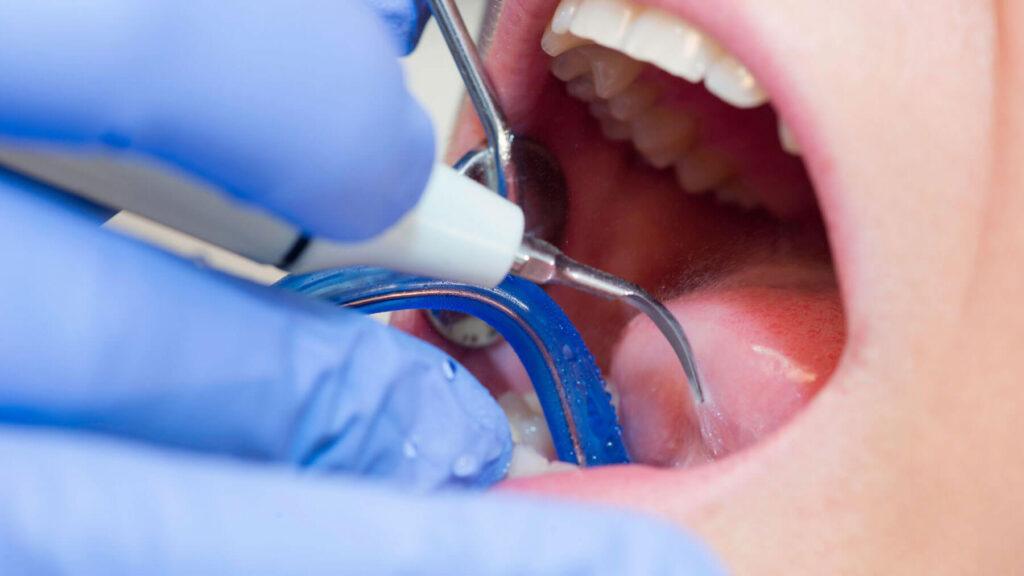 Revision For Dental Crown Intervention
