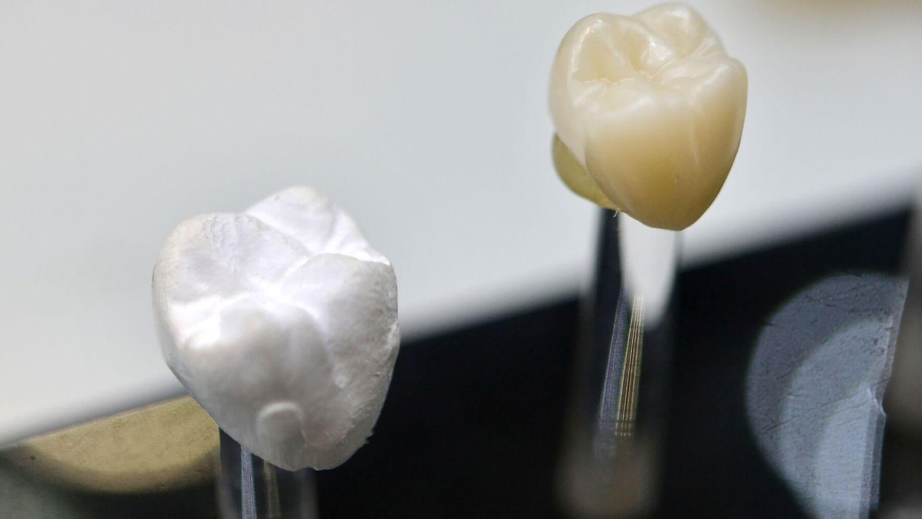 Dental Crowns in Carlsbad