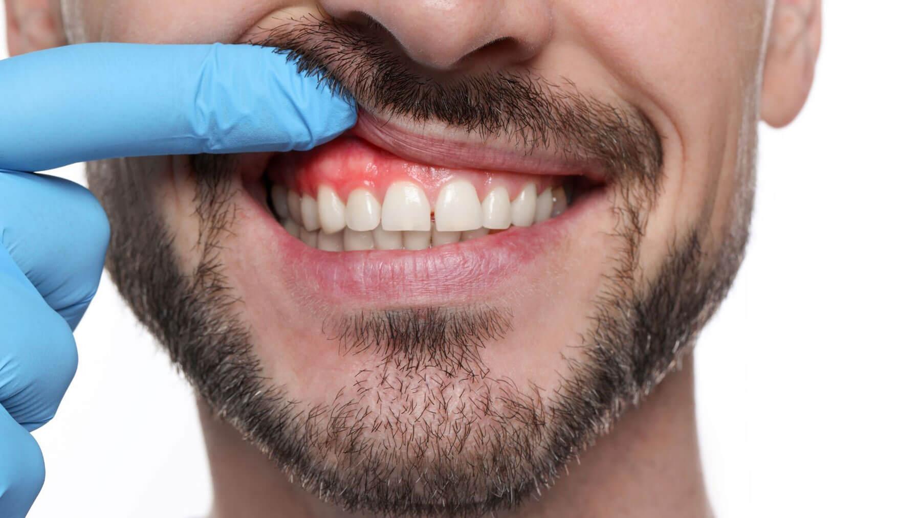 How A Tooth Infection Spreads
