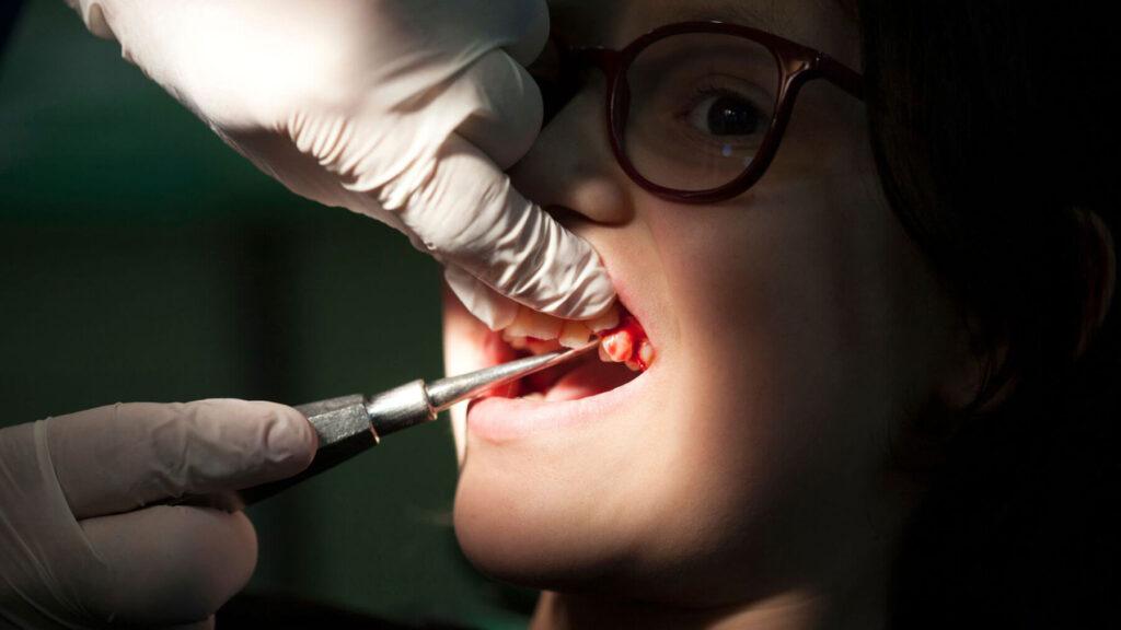 How Long Does a Tooth Extraction Take?