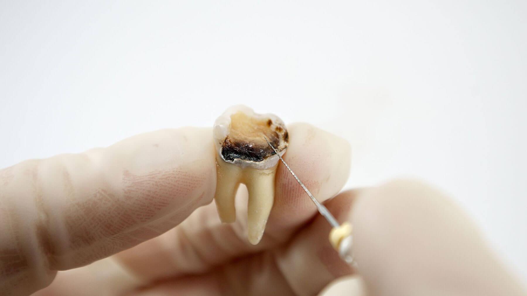Tooth Infection and Extraction - Smiles For Health