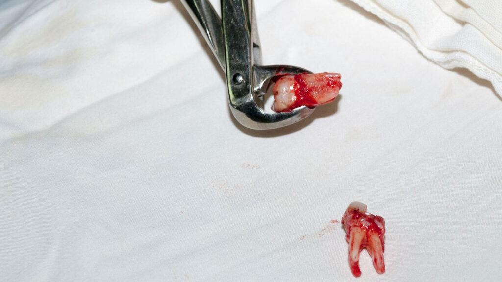 What Makes an Extraction “Simple”?