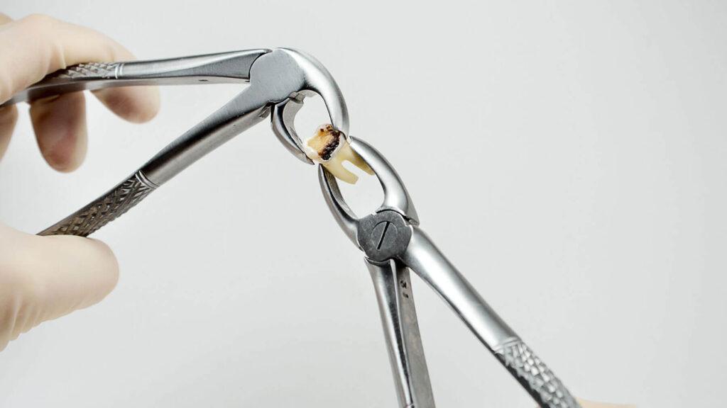 Stop Wisdom Tooth Pain Long-Term: When Extraction Is the Best Fix