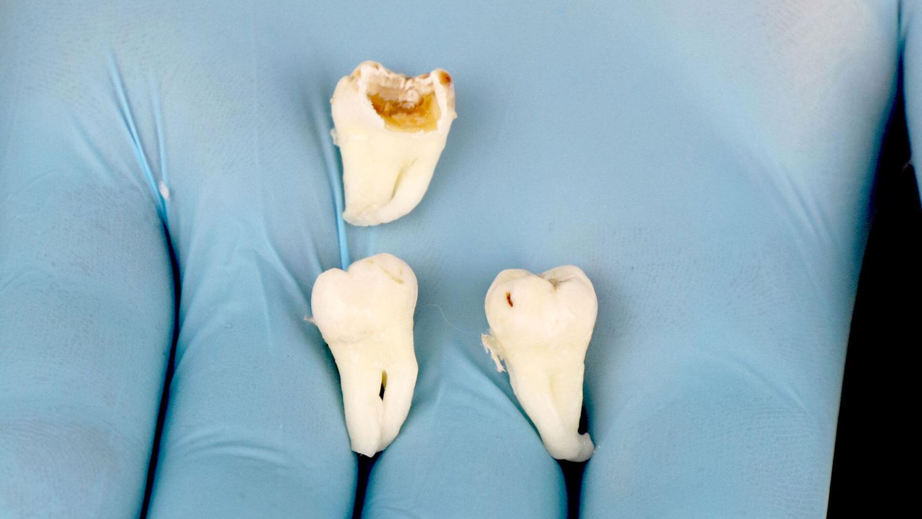 Wisdom Teeth Remove in Carlsbad