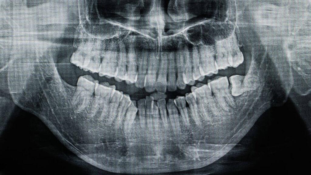 X-Ray For Pain to Wisdom Teeth